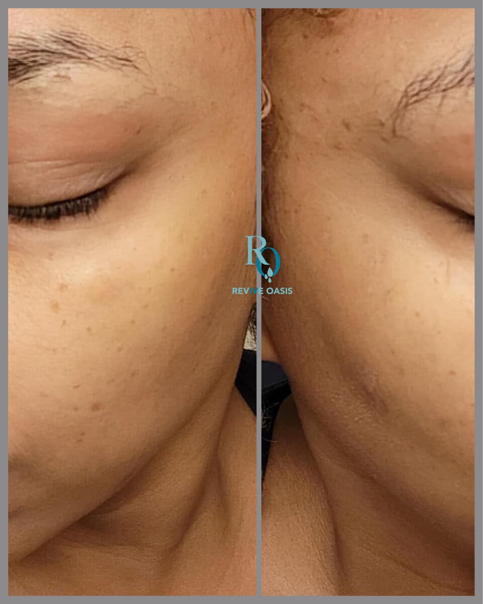 DPN removal — before and after